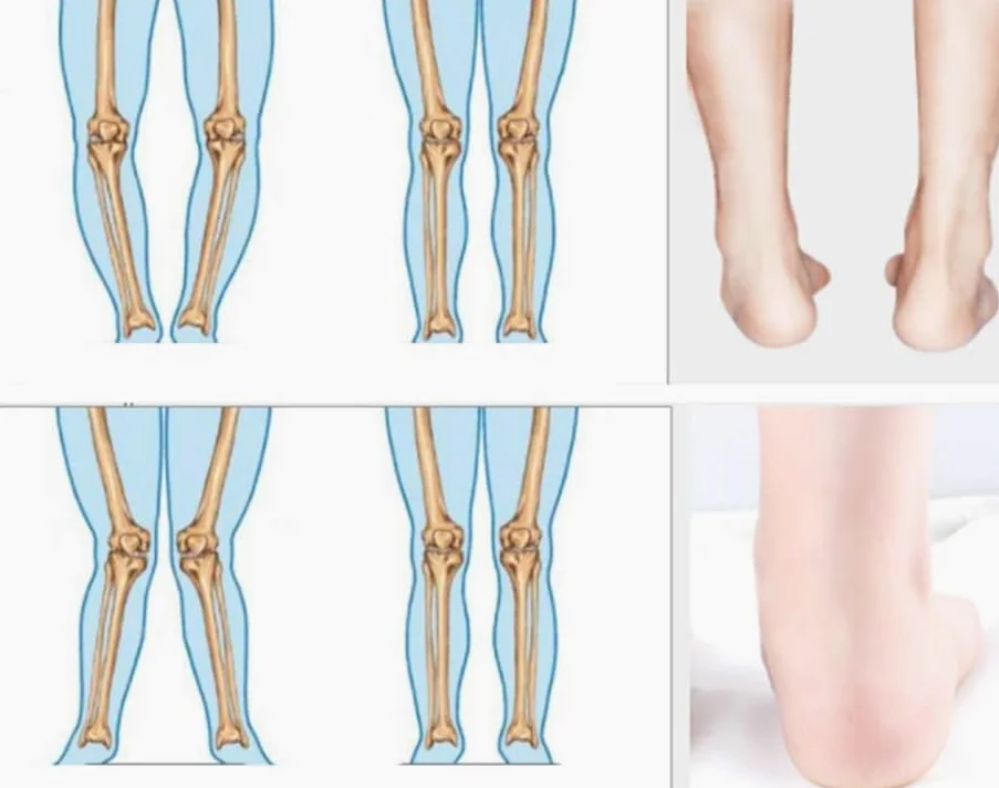 Solette Plantari Gambe Tipo X/o Inserti Ortopedici per Piedi Piatti, Fascite Plantare, Sperone Osseo, Sostegno, 43~44